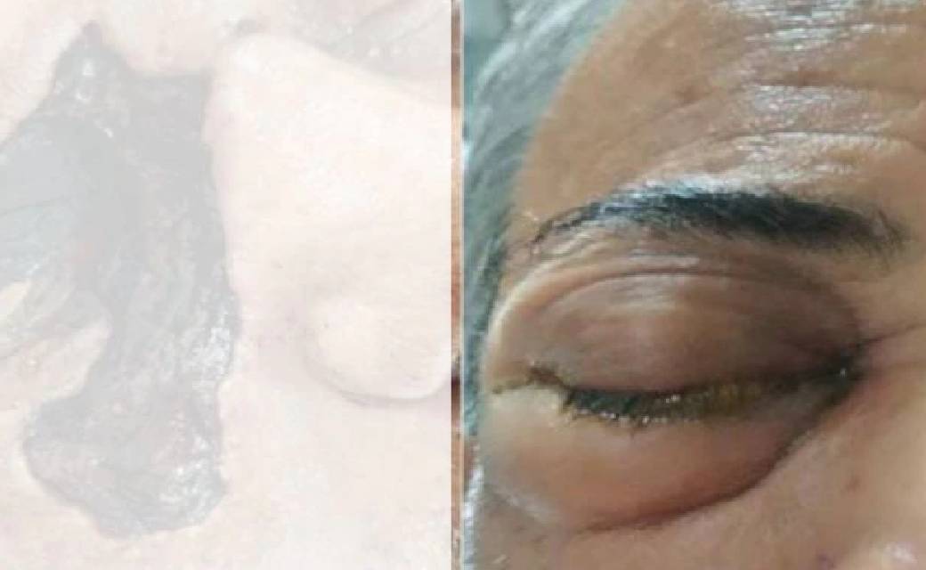 सरकार ने म्यूकोरमिकोसिस से लड़ने की खातिर एम्फोटेरिसिन बी की... - CG Sandesh