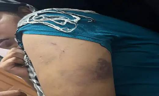  प्रेमी ने ब्रेकअप के बाद घर में घुसकर किया मारपीट ,पीड़िता न... - CG Sandesh