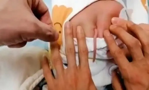 डॉक्टर से लेकर मां-बाप सभी हैरान...4 इंच पूछ के साथ हुआ बच्च... - CG Sandesh