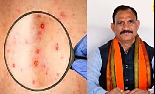 CG News: स्वास्थ्य मंत्री श्याम बिहारी जायसवाल ने मंकी पॉक्स की रोकथाम और नियंत्रण के लिए जारी की एडवाइजरी, स्वास्थ विभाग को दिए दिशा निर्देश