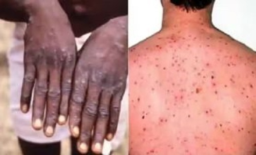 मंकी पॉक्स (एम-पॉक्स) नामक बीमारी के बचाव व रोकथाम हेतु एडवायजरी जारी