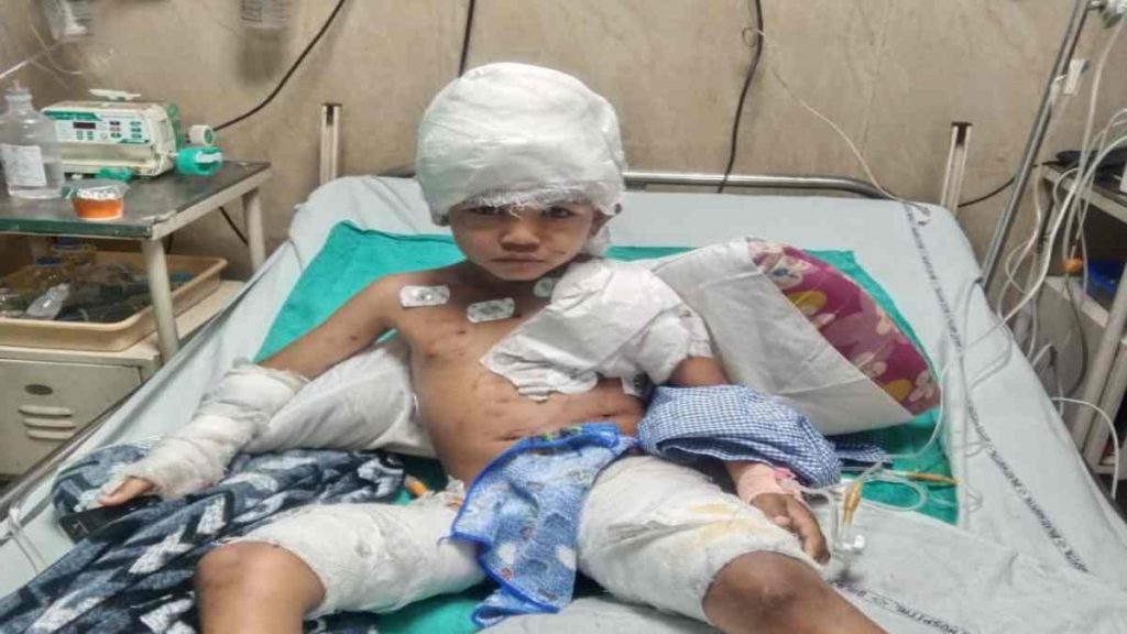 CG : आवारा कुत्तों ने 6 साल के बच्चे पर किया हमला, सिर और पीठ का मांस नोंचा