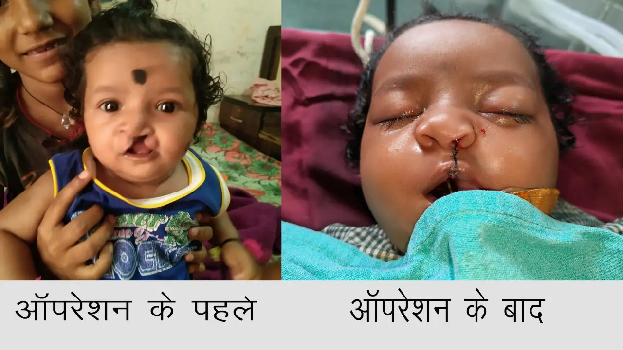 CG : चिरायु योजना ने लौटाई मासूमों की मुस्कान, जन्मजात और गं... - CG Sandesh